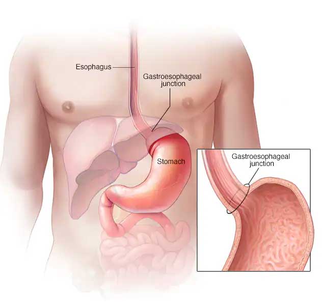 Gastric Cancer Hospitals in pune, pcmc