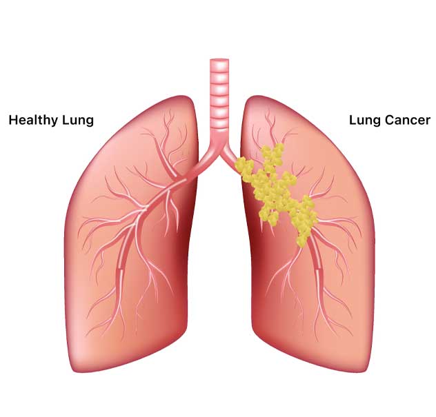 TARGETED THERAPY FOR CANCER TREATMENT - Dr. ReshmaPuranik