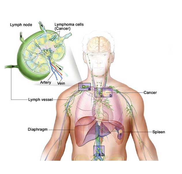 Lymphoma Cancer in Pune