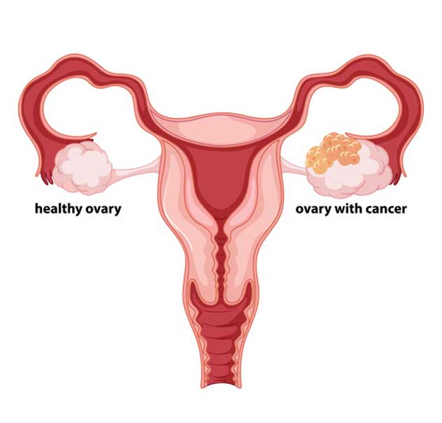 Ovarian Cancer Hospitals in pune, pcmc