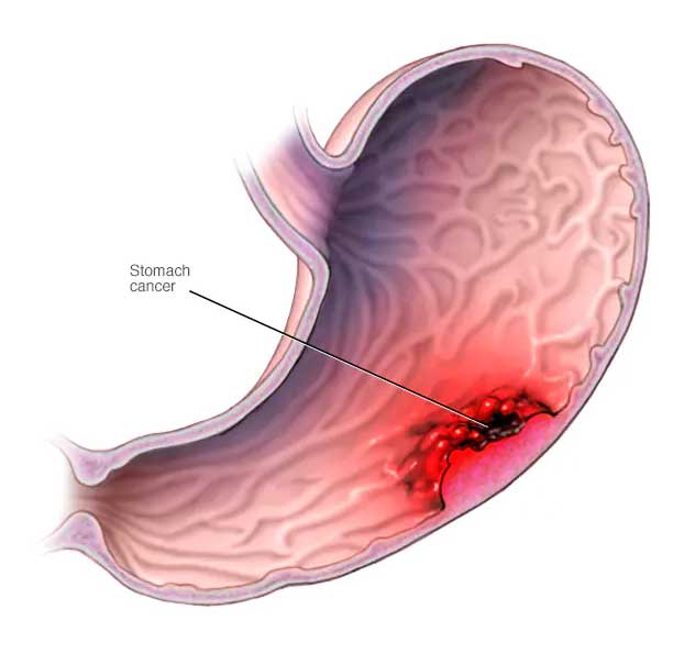 Stomach Cancer in Pune